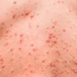 Récord de sífilis en Argentina