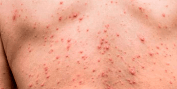 Récord de sífilis en Argentina